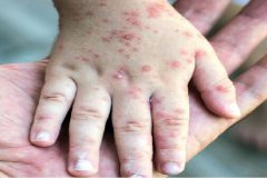 سرخک یک بیماری ویروسی و بسیار مسری/ تا کنون موردی در استان مرکزی مشاهده نشده