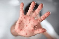  آبله میمونی یک ویروس جدید و نوپدید نیست/ کودکان کمتر از ۱۶ سال یکی از گروه های هدف بیماری